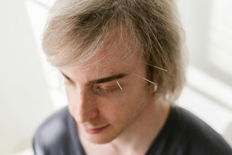 Facial acupuncture treatment for various ailments such as Bell's Palsy