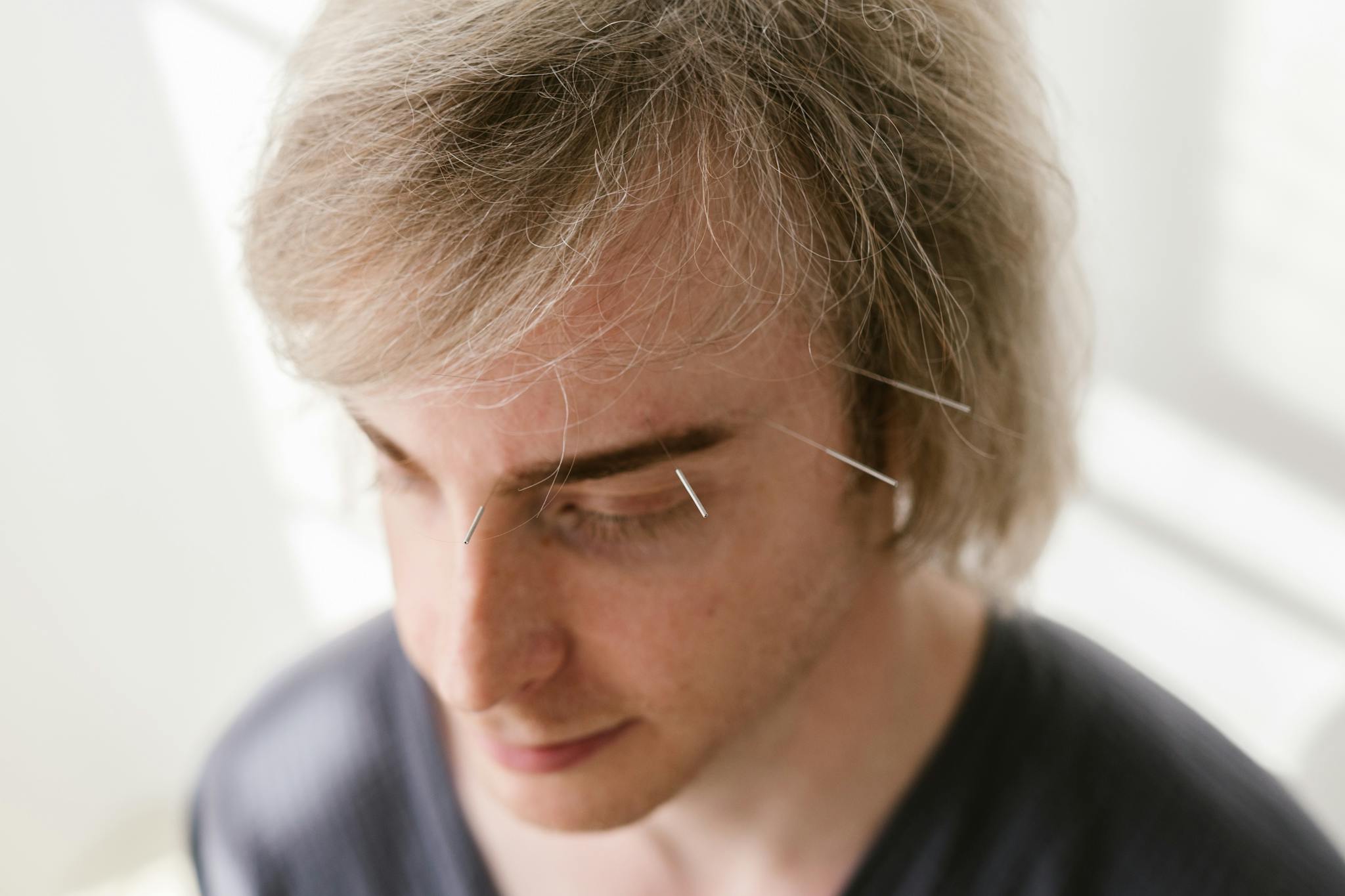 Facial acupuncture treatment for various ailments such as Bell's Palsy